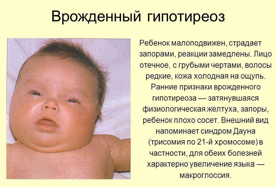 Кретинизм у детей и взрослых — причины и виды болезни