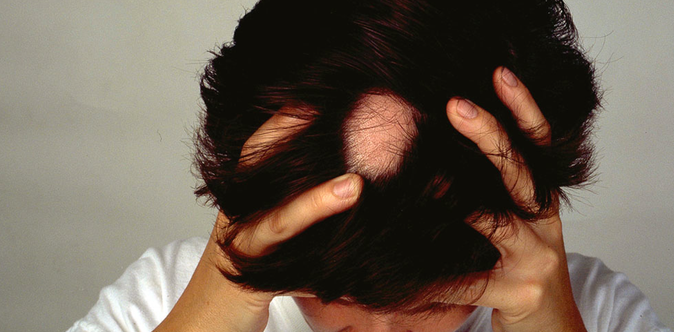 Выпадение волос от стресса: что делать и как лечить, если выпадают волосы от стресса – лаборатория ан-тек