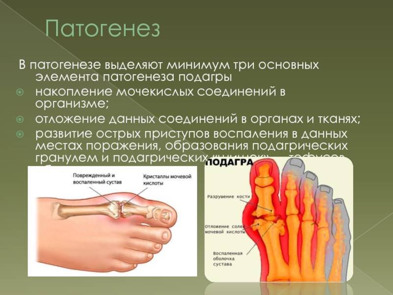Заболевание ревматоидный артрит - меры профилактики