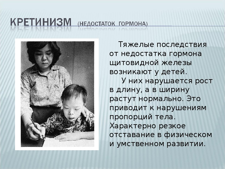 Кретинизм - симптомы, причины, лечение, признаки кретинизма
