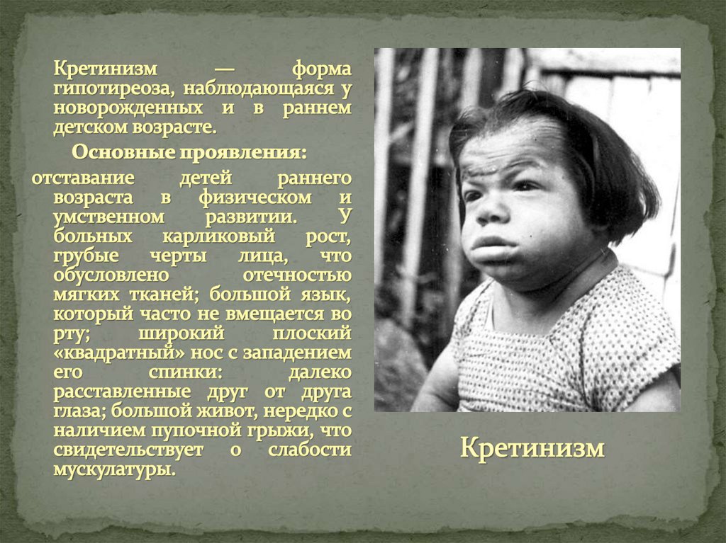 Кретинизм - причины и симптомы у детей и взрослых, что это такое?