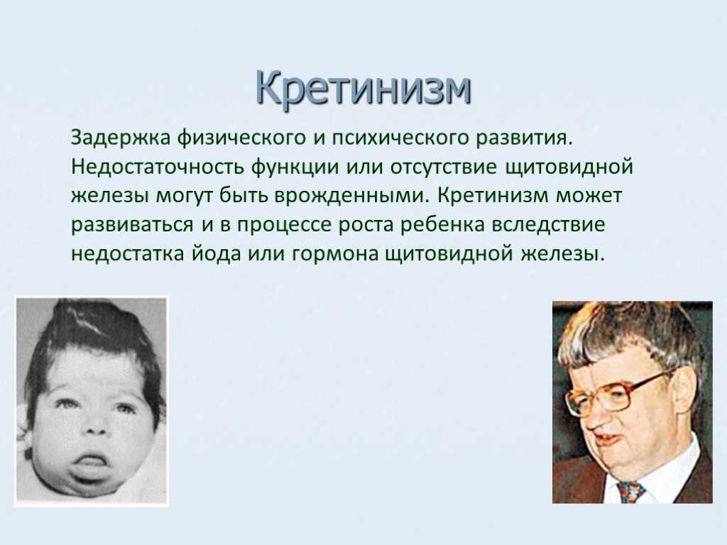 Кретинизм - причины, симптомы, лечение и профилактика