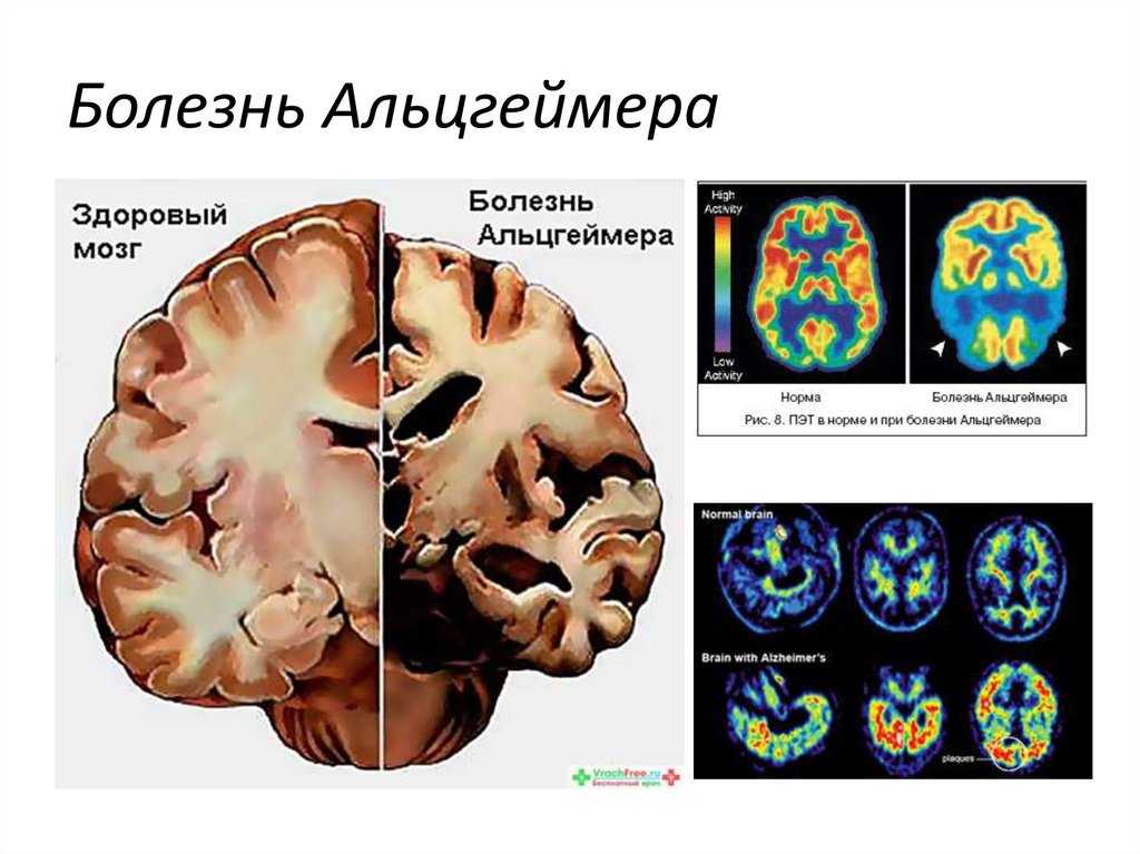 Болезнь альцгеймера – что это? 7 стадий, причины и признаки